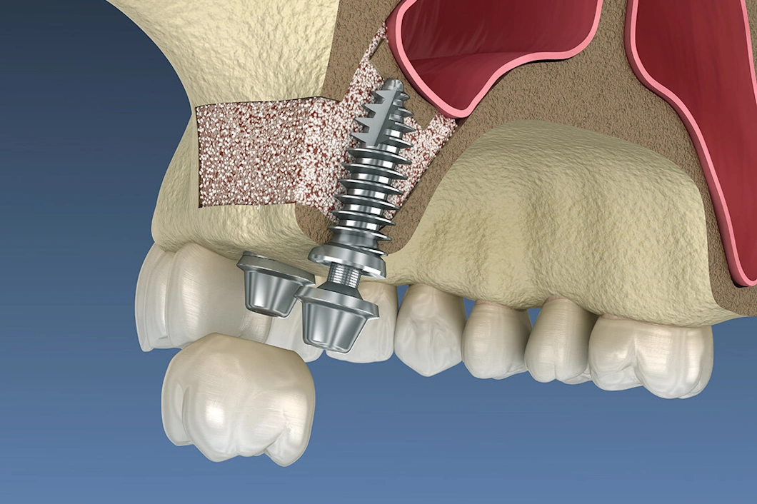 bone grafting