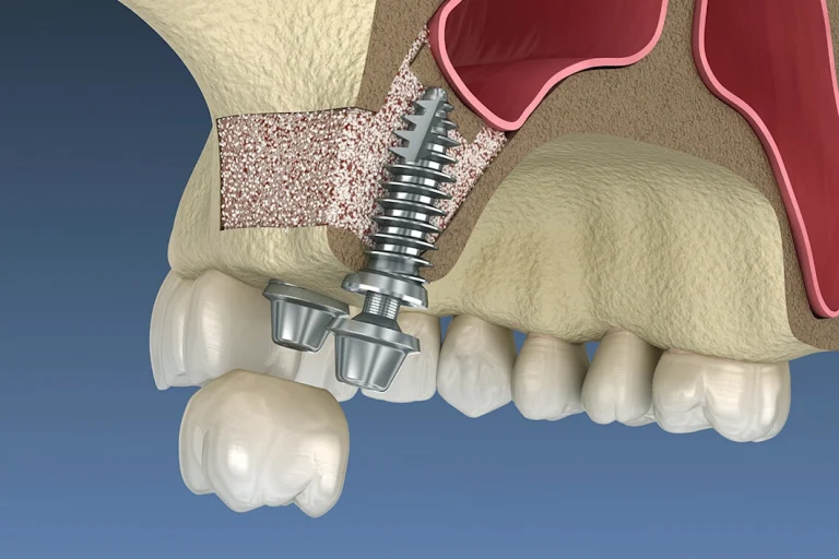 bone grafting