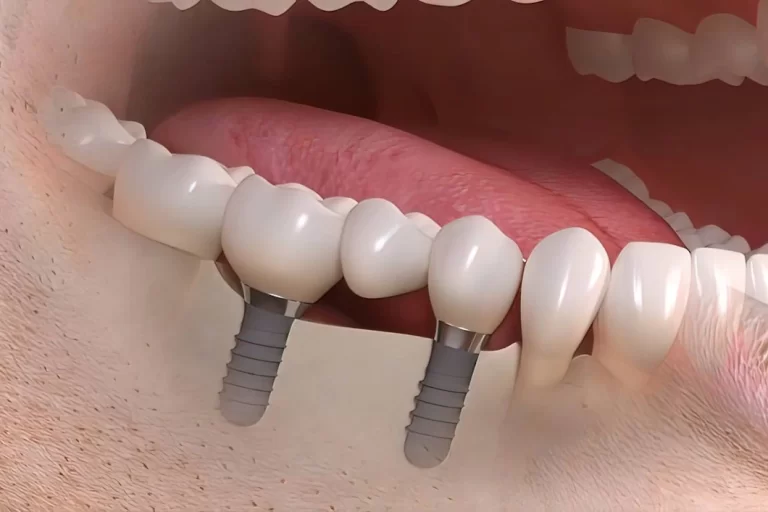 implant-supported-bridges