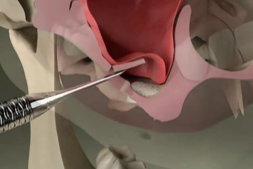 sinus lifting